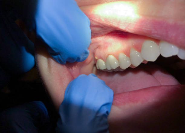 Best Emergency Root Canal Treatment in Oak Ridge, FL